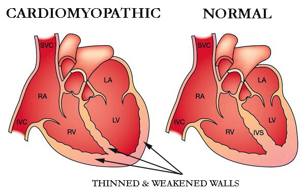 Comprehensive Report on Cardiomyopathy Market 2019 Overview, Analysis and Trends, Focusing on top key players like Array BioPharma, Boston Scientific, Cisbio, Covance, Critical Diagnostics, Mylan and others