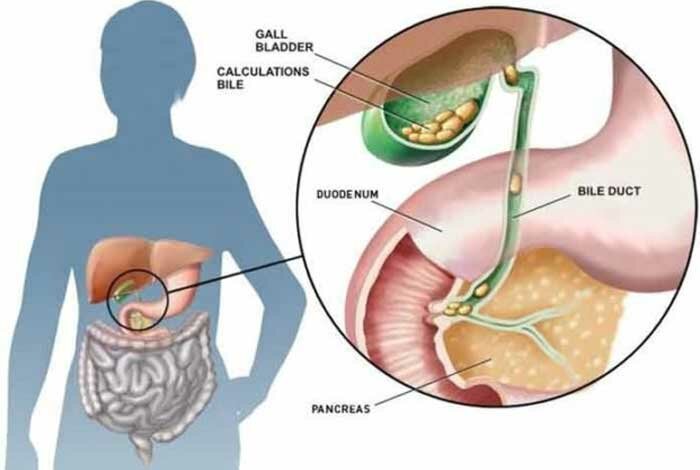 Latest Research on Cholelithiasis Market Outlook, Research, Trends and Forecast to 2026