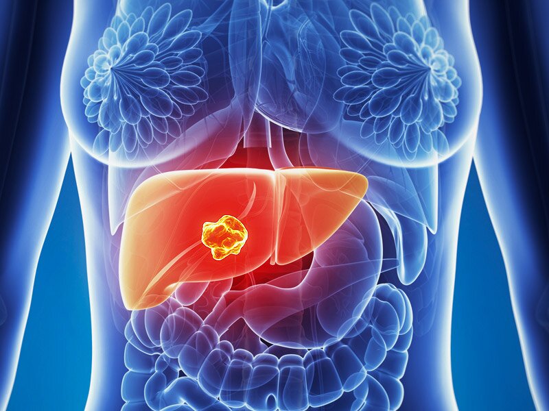 Global Nonalcoholic Steatohepatitis Market Report, Trends, Size, Share, Analysis, Estimations and Forecasts to 2024