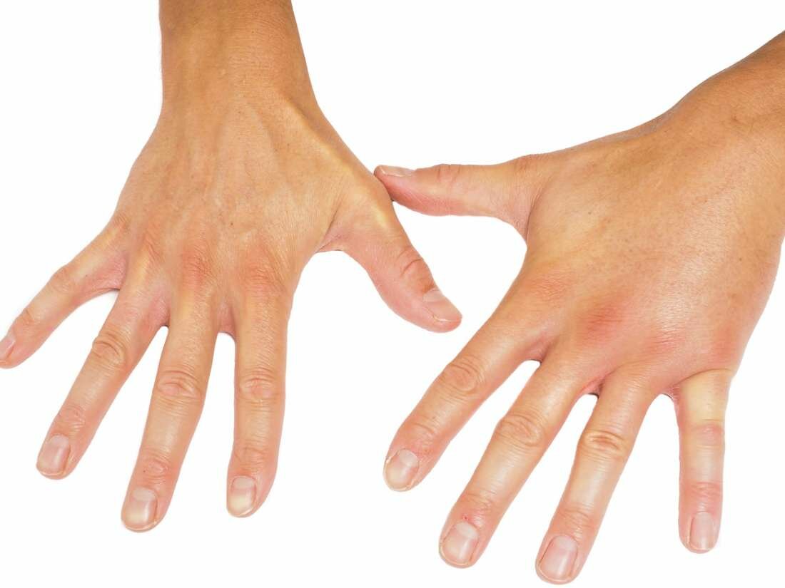 Raynauds Disease Treatment Market 2019 Competitive Trends, competitive strategies with prominent companies by Allergan Plc, Apricus Biosciences, Bayer AG, Covis Pharmaceuticals