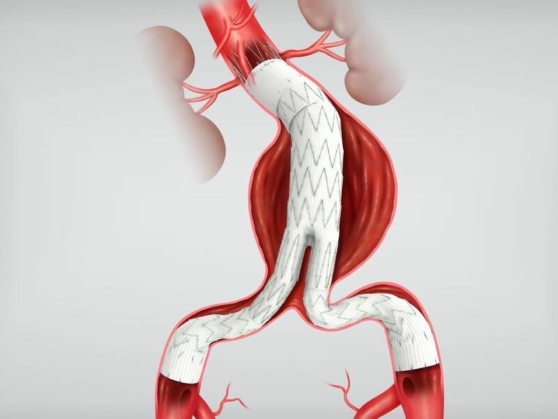 Global Aortic Stent Grafts market (2019-2023) is growing at a CAGR of +11% with major key players like are Cook Medical, Inc., W.L. Gore & Associates, MicroPort Scientific Corporation Inc.