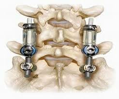 Latest Updated Report on Pedicle Screw-Based Dynamic Stabilization Systems Market 2019-2026| by Major Companies: Zimmer Spine, Inc., Globus Medical, Inc., Bio-Spine Corp., Applied Spine Technologies, Ulrich GmbH & Co, Medtronic Sofamor Danek, Synthes Spine